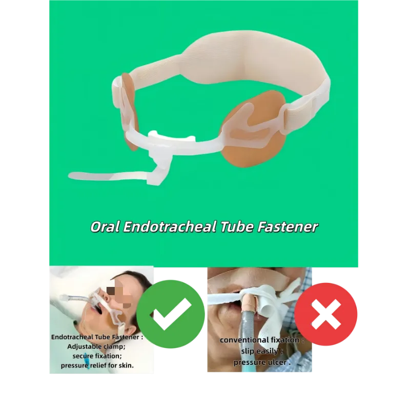 Endotracheális csőrögzítő